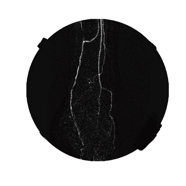 Ayak dorsal arteri anjiyografisi