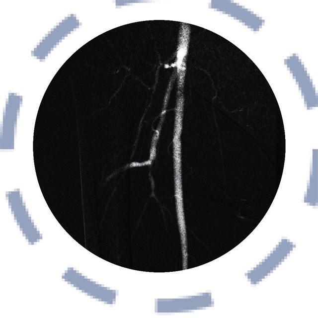 Femoral arter anjiyografisi